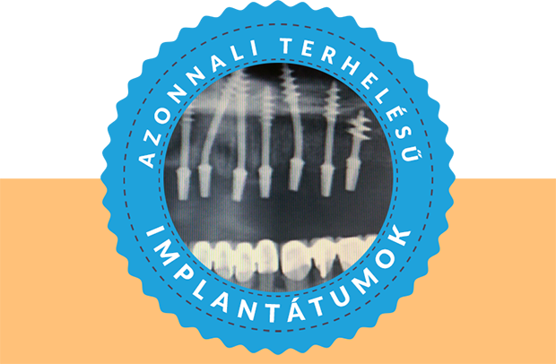 IHDE azonnali terhelésű implantáció