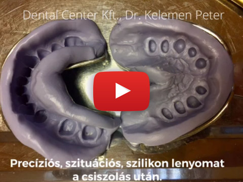 Fogpótlás esetbemutató